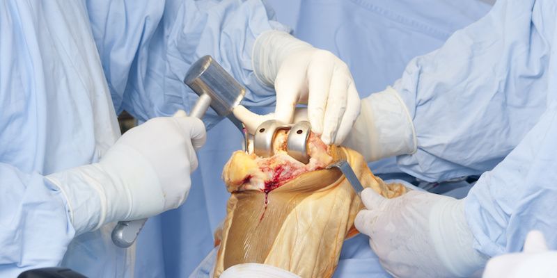 Cuánto Cuesta Una Cirugía De Rodilla En México Dr Daniel Machuca